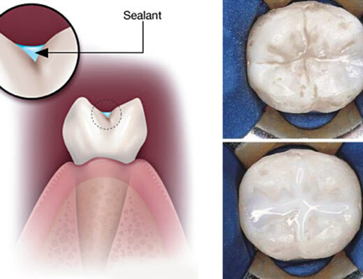 sealants NEW