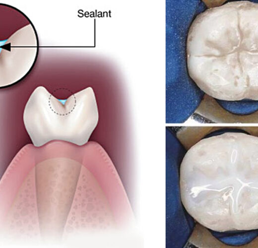 sealants NEW