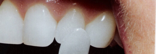 veneers-3-1140x640