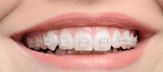 white-braces-670x431